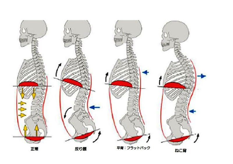 反り腰下腹ポッコリ